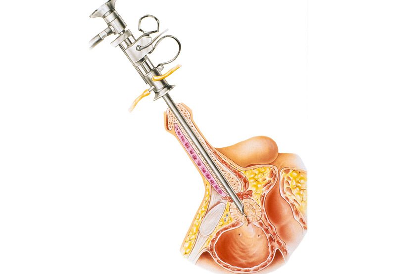 An-image-depicting-surgical-procedure-of-transurethral-resection-of-the-prostate