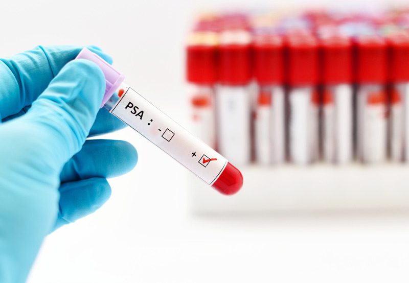 Blood-test-for-PSA-levels-used-in-prostate-cancer