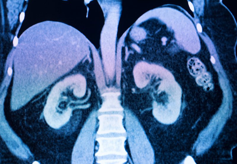 CT-scan-view-for-kidney-stone-diagnosis