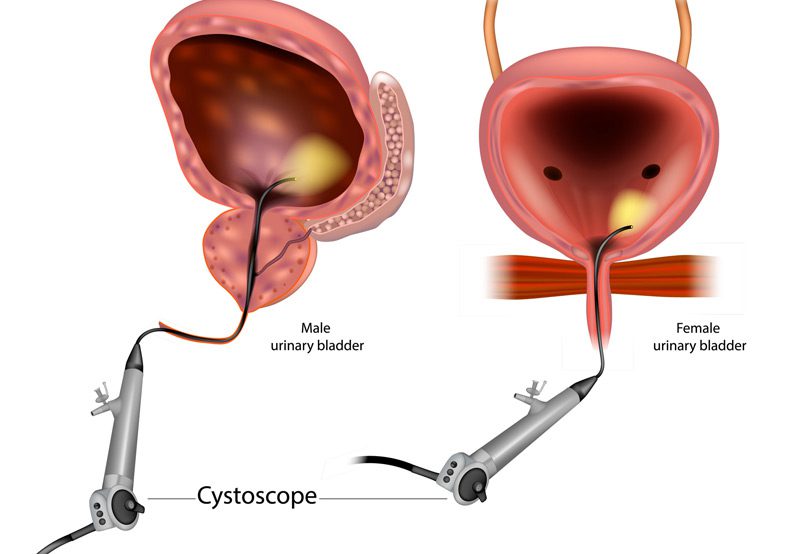 Diagram-showing-a-flexible-cystoscopy