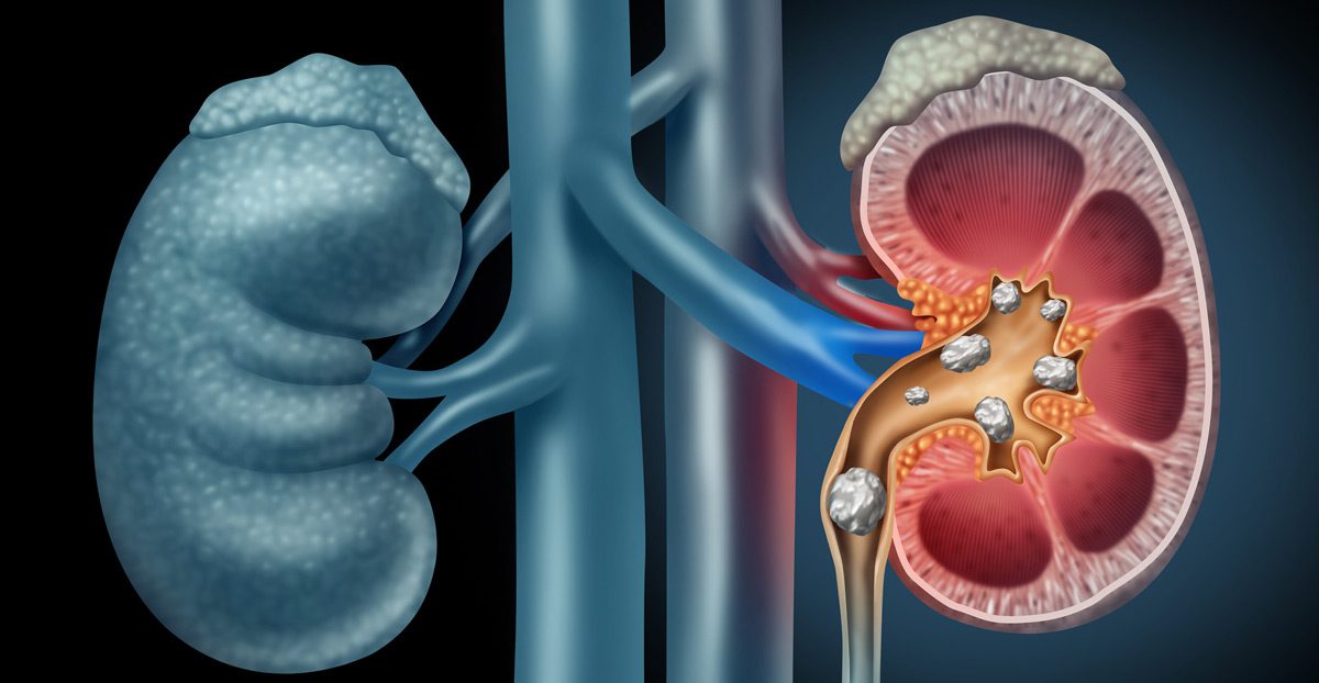 Illustraion-of-kidney-stones