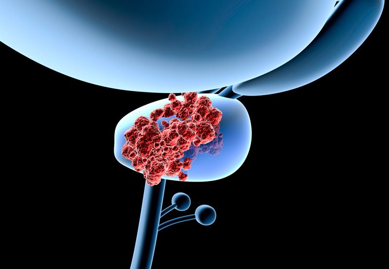 Illustration-showing-MRI-scan-of-prostate-for-cancer
