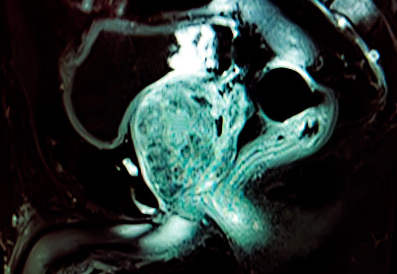 MRI-scan-showing-prostate-gland-imaging