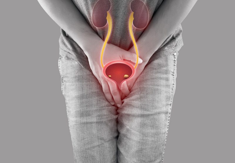 Medical-illustration-showing-bladder-stones-inside-the-urinary-bladder