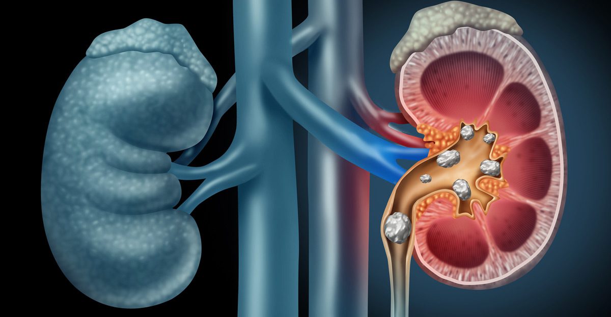 Medical-illustration-showing-kidney-stones