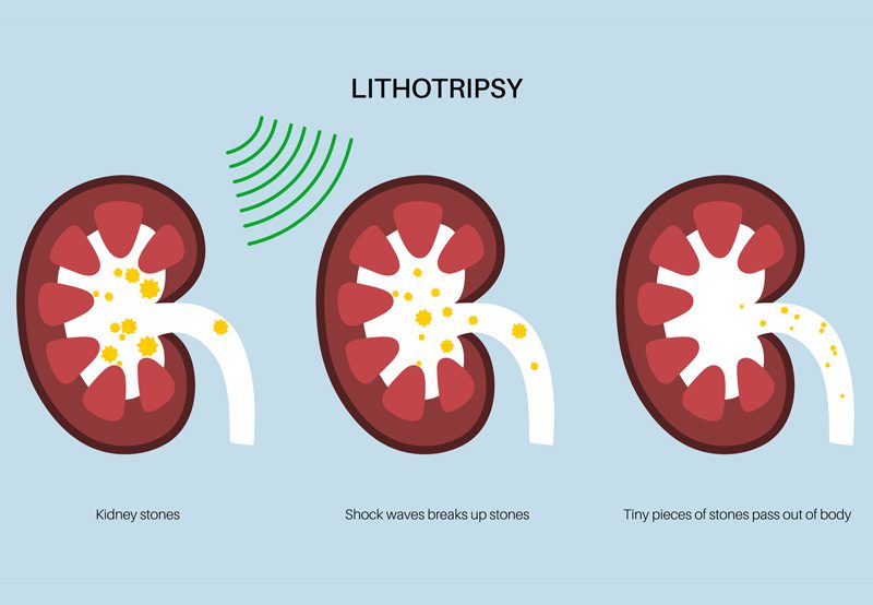 Vector-showing-the-stages-of-lithotripsy
